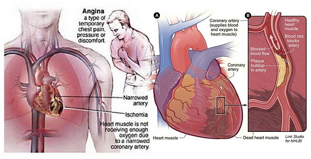 Unduh 96+ Gambar Gangguan Jantung Terbaik HD